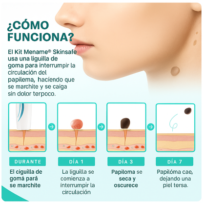 SkinOff Pro™ – Kit para la eliminación de verrugas y marcas en la piel