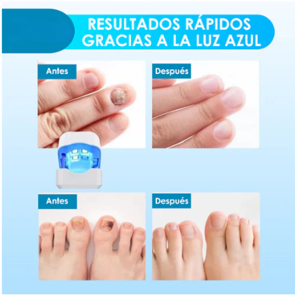 Laser pour ongles de pieds et de mains - le meilleur traitement pour vos ongles - pratique et fiable