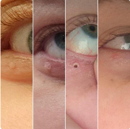 SkinOff Pro™ – Kit para la eliminación de verrugas y marcas en la piel