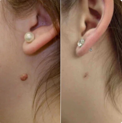 SkinOff Pro™ – Kit para la eliminación de verrugas y marcas en la piel